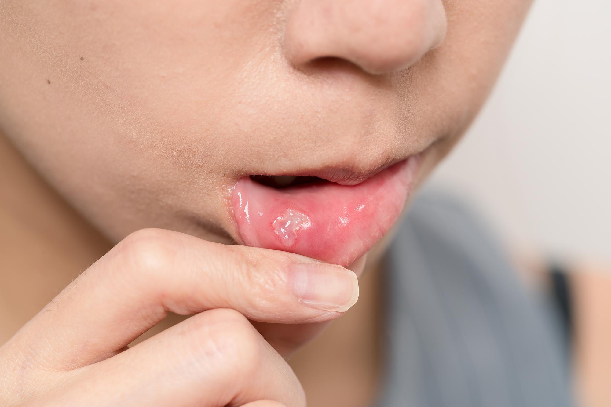 Que se passe-t-il dans ta bouche quand un aphte apparaît ?