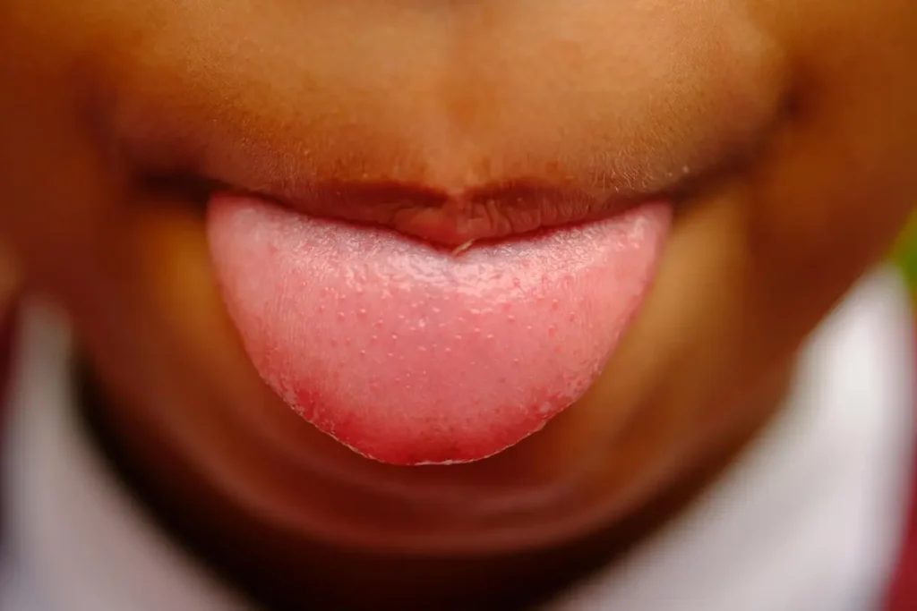 langue candidose bouche